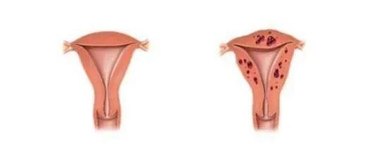 子宫腺肌症必须手术治疗吗？