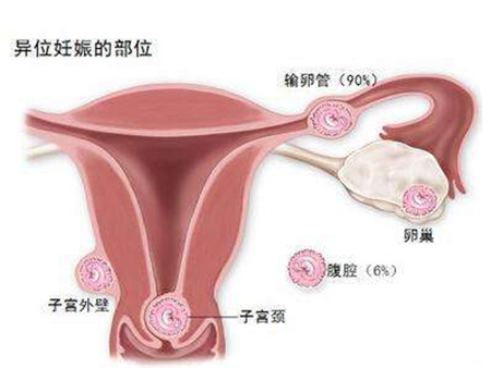 【宮外孕概率有多大】宮外孕的概率有多高_宮外孕的發生率是多少
