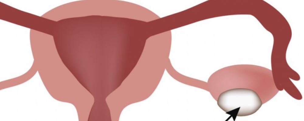 查出子宫肌瘤需要动手术吗 这些情况不用做