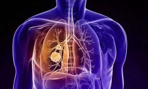 肺结节是怎么回事？肺结节会是早期肺癌吗？