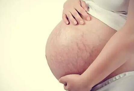 如何预防妊娠纹 宝妈长妊娠纹具体是几月份长的？