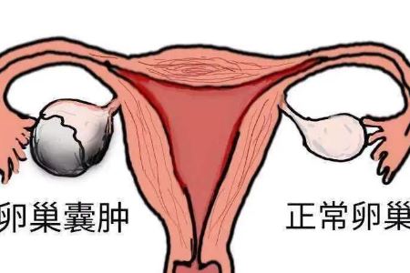 卵巢囊肿的危害以及预防的方法
