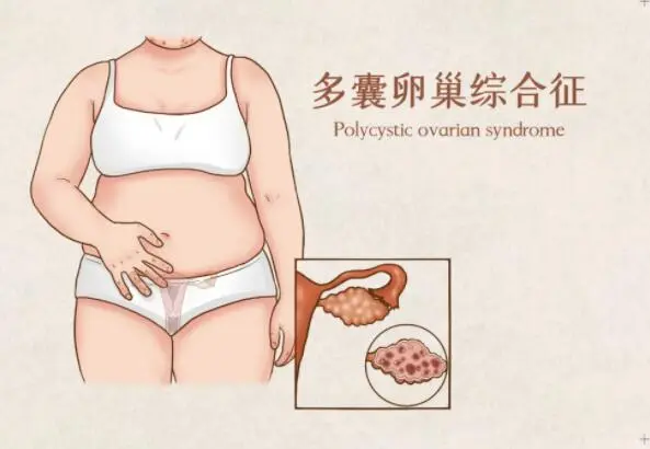 多囊卵巢综合征可以自然怀孕么