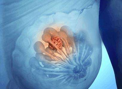 乳腺增生早期症状图片图片