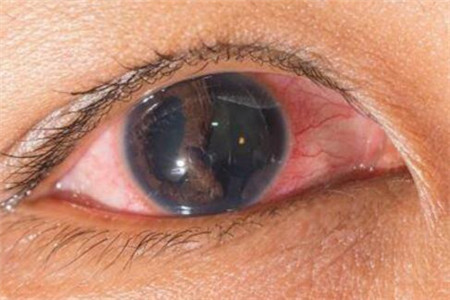 女人眼睛有红血丝或是这四种原因